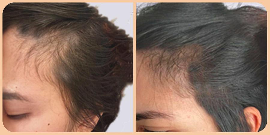 🔥🔥Gyors hajnövekedés keverék 🔥🔥🎉 Hatékony kezelés a hajhullásra Növelje a haj mennyiségét gyorsan🎉